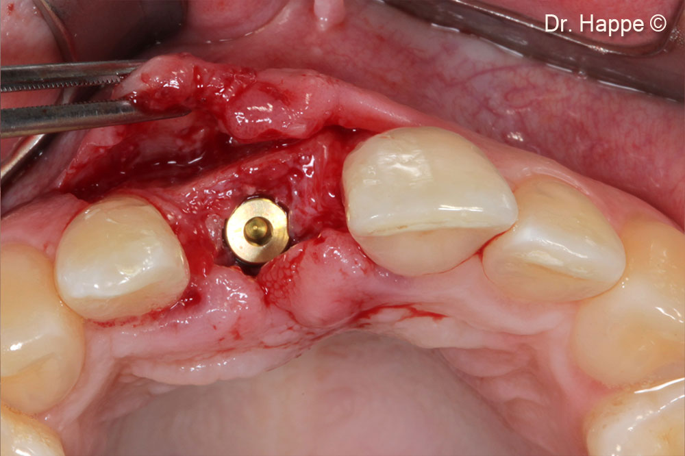 3.8mm diameter implant in place. Ready for transmucosal healing