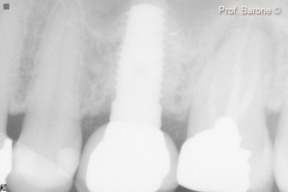 Periapical Radiograph at 3-year follow up