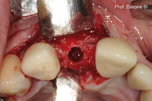 Implant site preparation