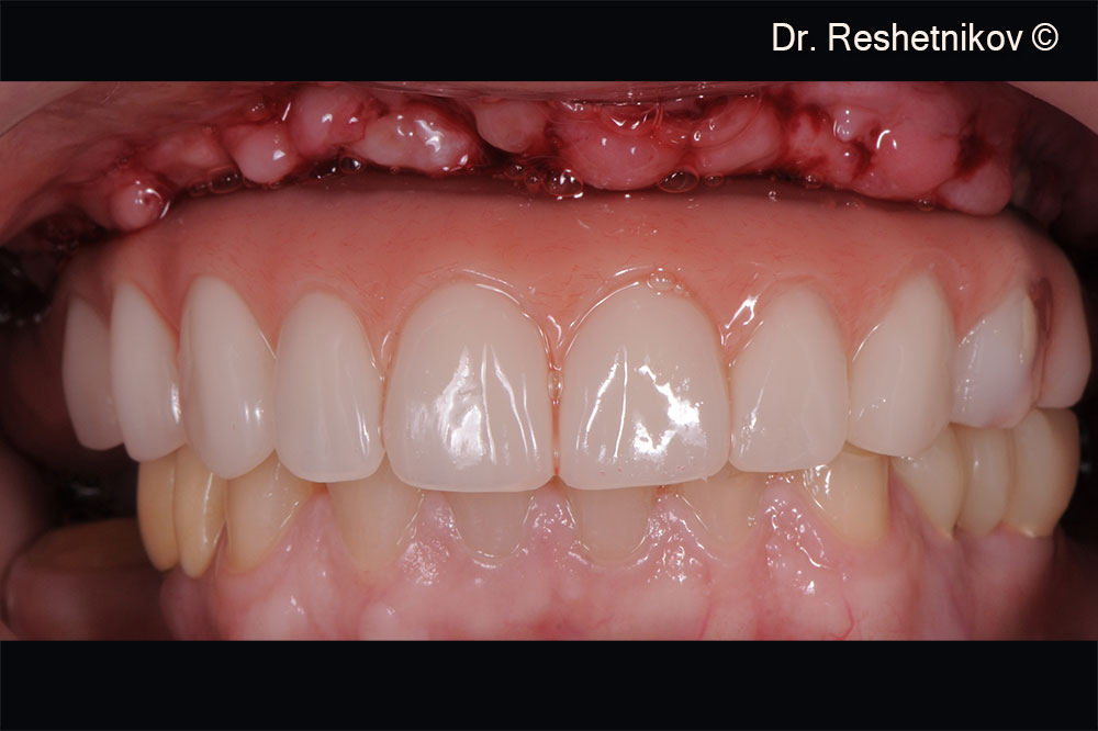 Temporary prosthetics of the upper jaw supported by implants