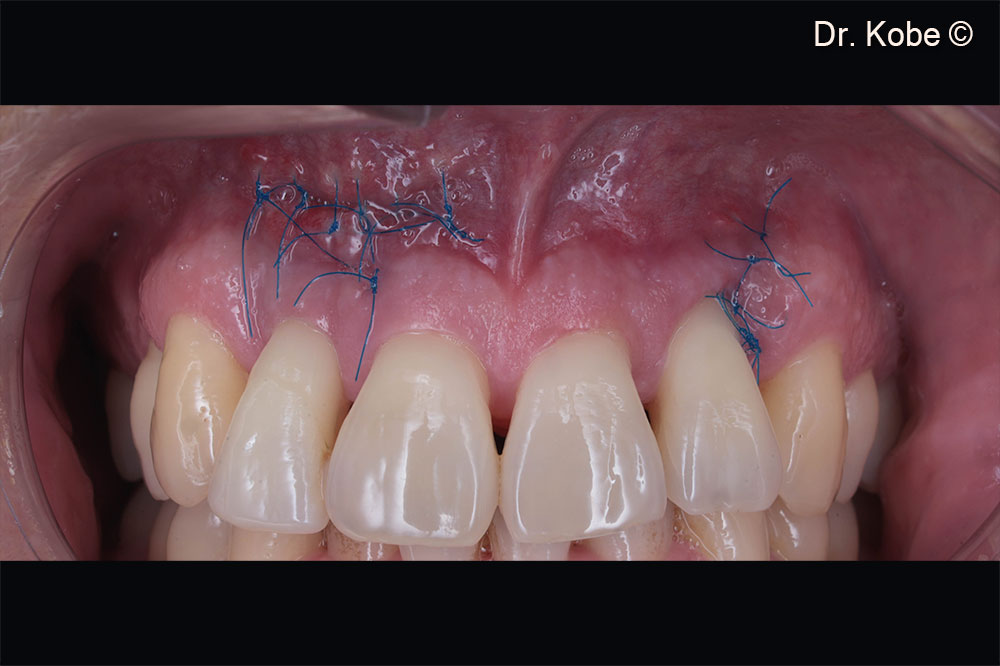 Complete wound closure after two week