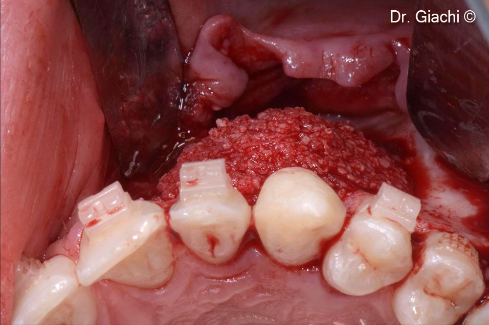 Bone reconstruction with fully resorbable collagenated biomaterial – occlusal view