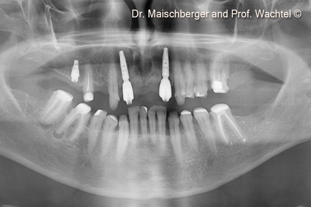 Healed soft tissue situation after bone and soft tissue grafting.