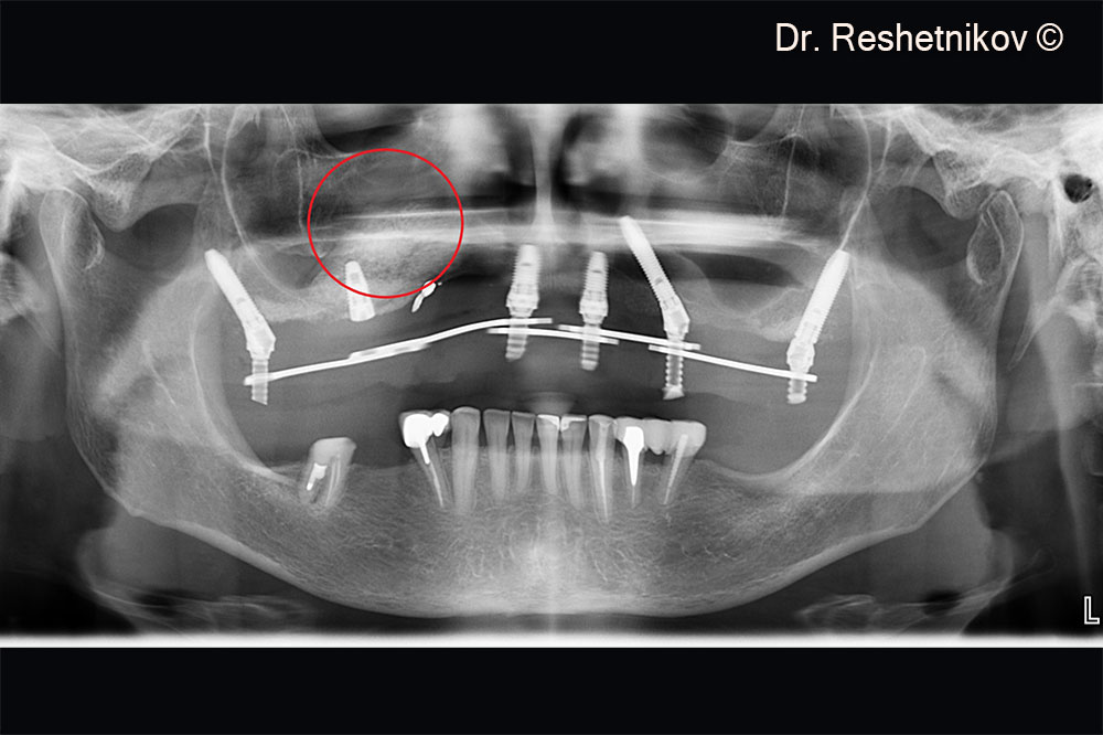 Panoramic radiograph on the day of surgery. Temporary reinforced plastic prosthesis installed
