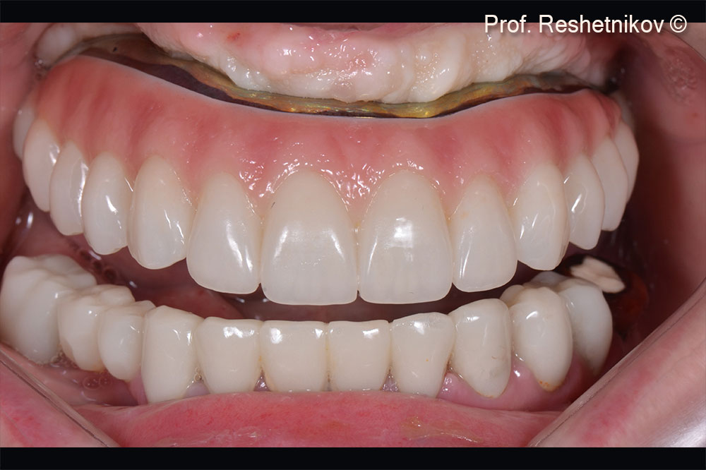 View of a fixed permanent titanium-ceramic prosthesis on maxillary implants 8 months after surgery
