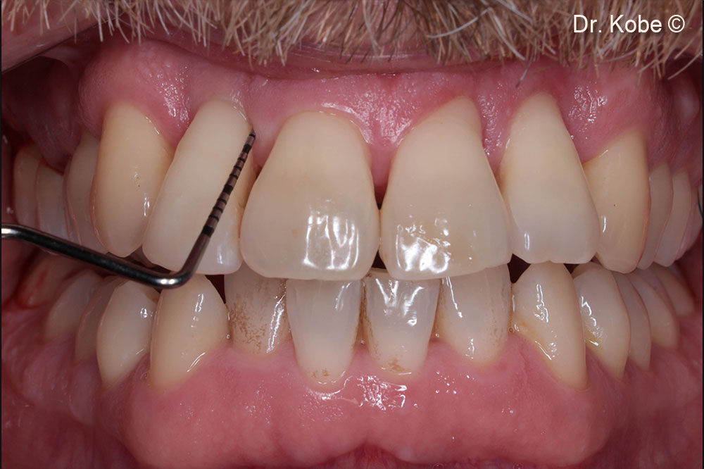 1-year follow-up in the first quadrant