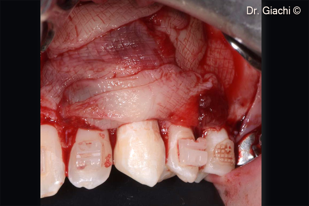 Graft protection with L-PRF membranes