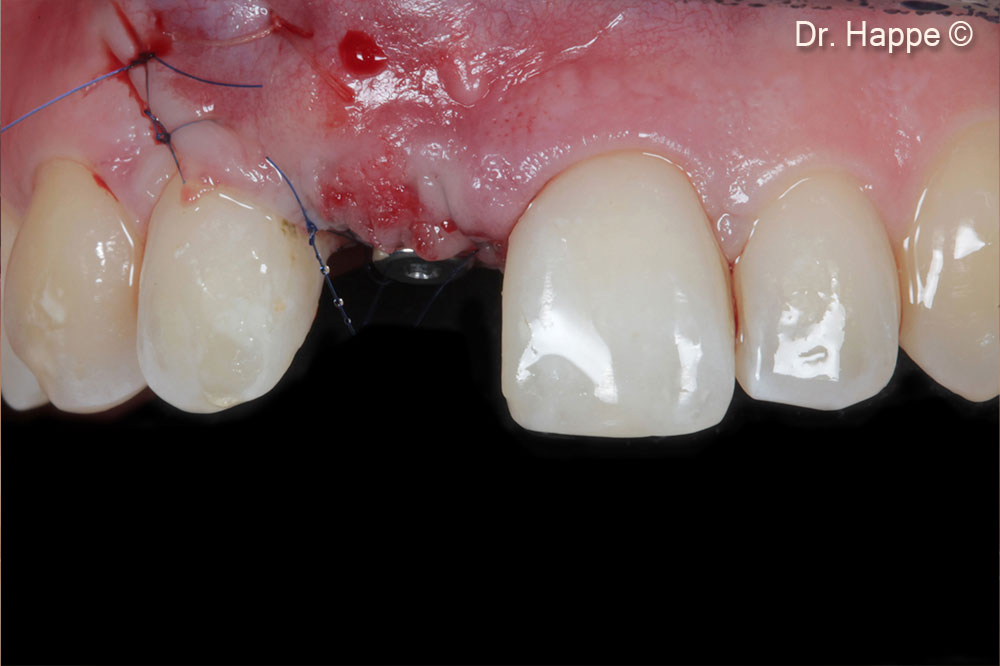 Post-OP situation after implant placement and soft-tissue augmentation.