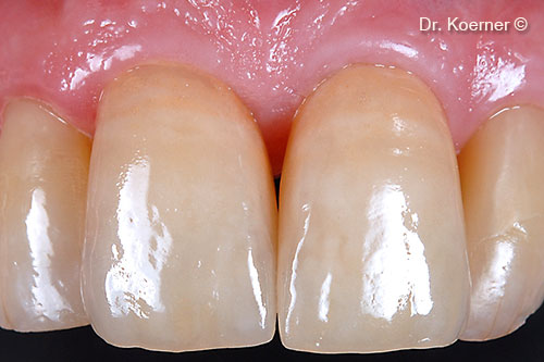 Final restoration with ceramic veneers 13-23