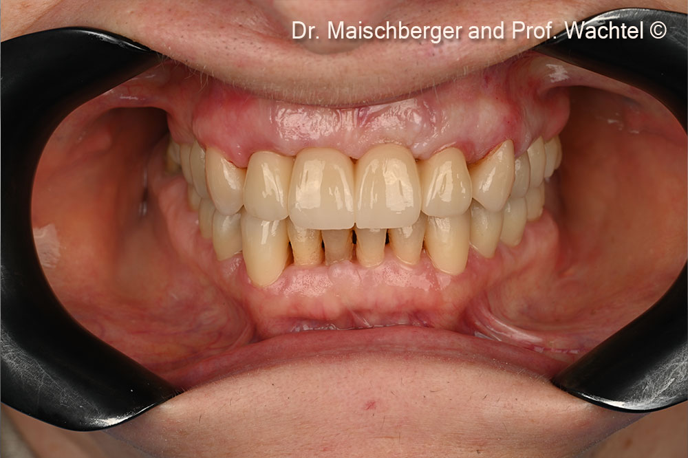 X-ray after implantation and augmentation. Endodontic retreatment #46/#47 was performed later
