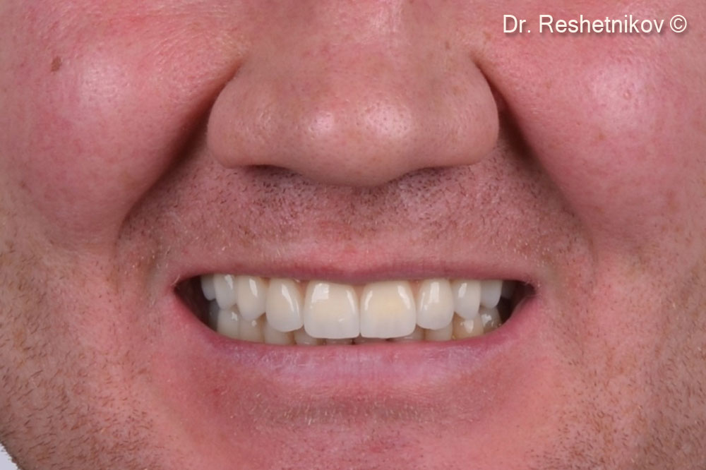 Patient's smile after permanent prosthetics