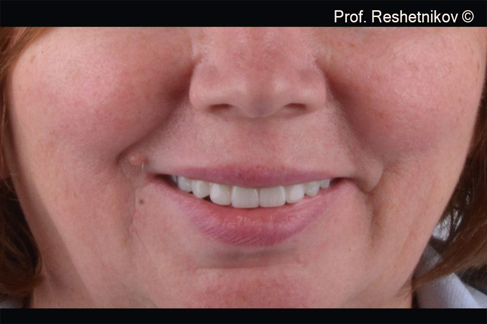 Patient’s smile with permanent construction on the upper jaw