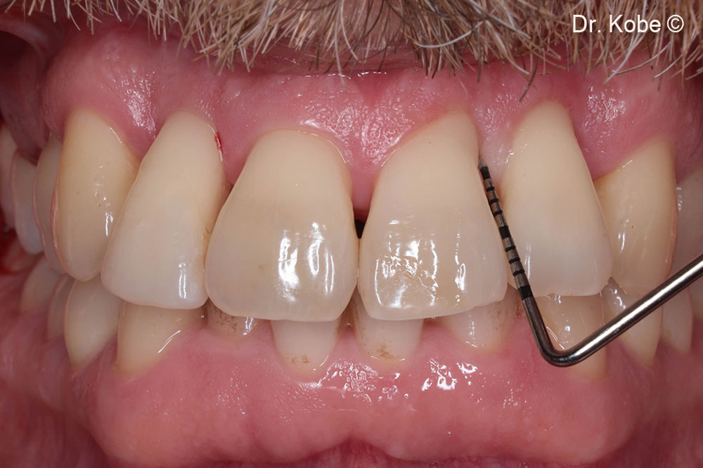1-year follow-up in the second quadrant