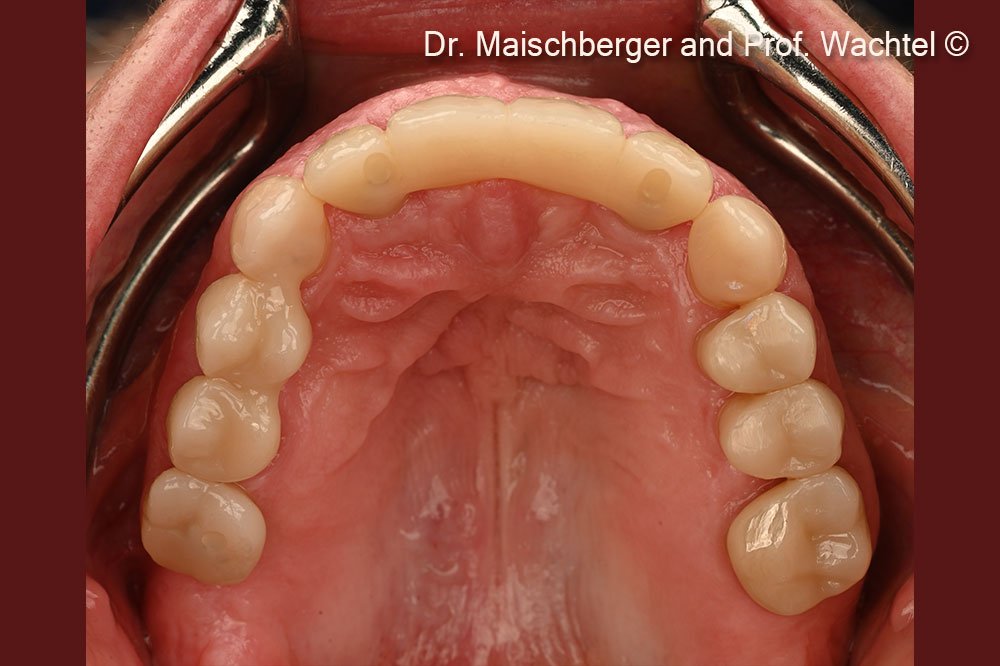 Final restoration – frontal view.