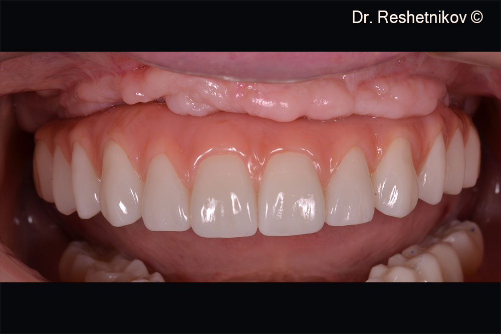 Patient's smile after permanent prosthesis fixated