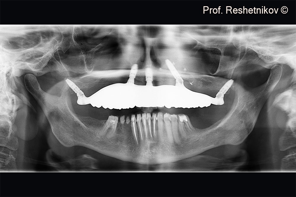 Final panoramic radiograph with a permanent prosthesis installed