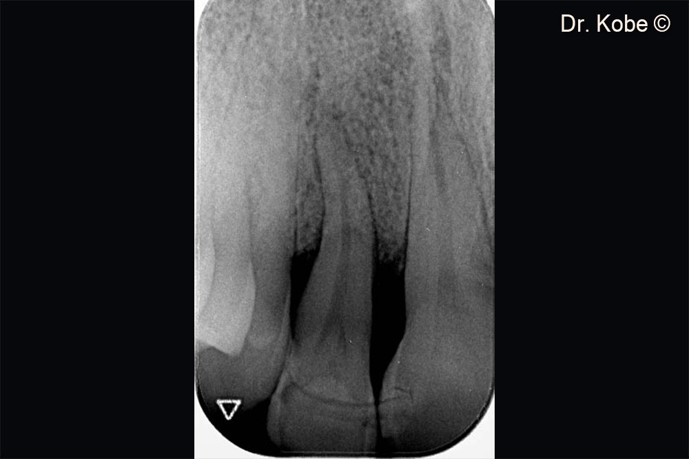 Radiograph 1 year after treatment