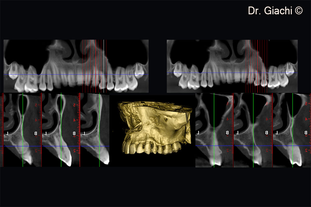 3-year follow-up CBCT showing bone remodeling and new bone formation on the vestibular cortical plate