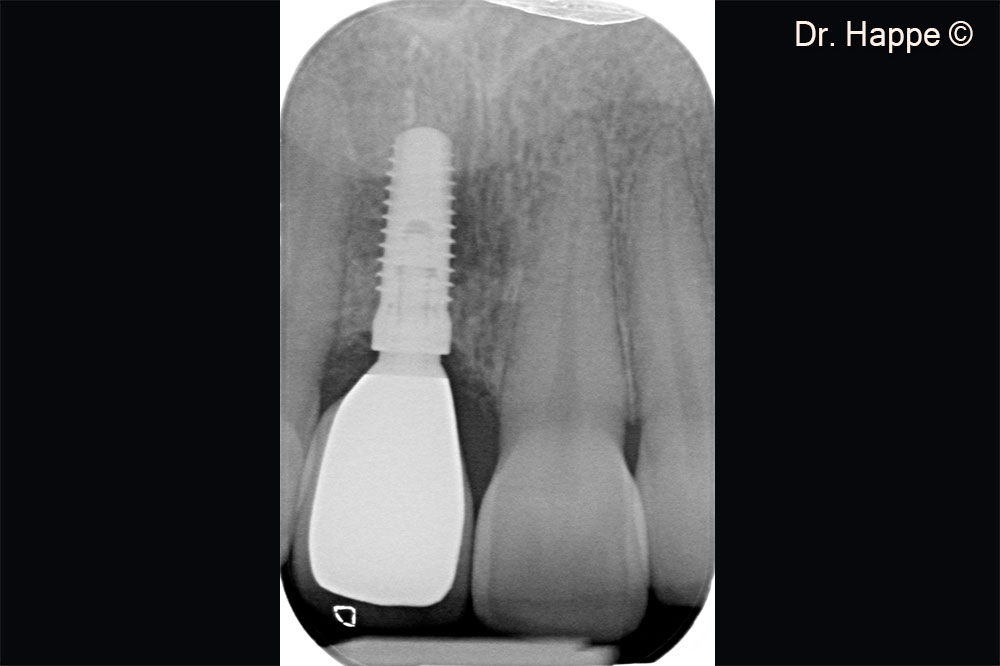 Peri-apical X-ray of the final restoration.