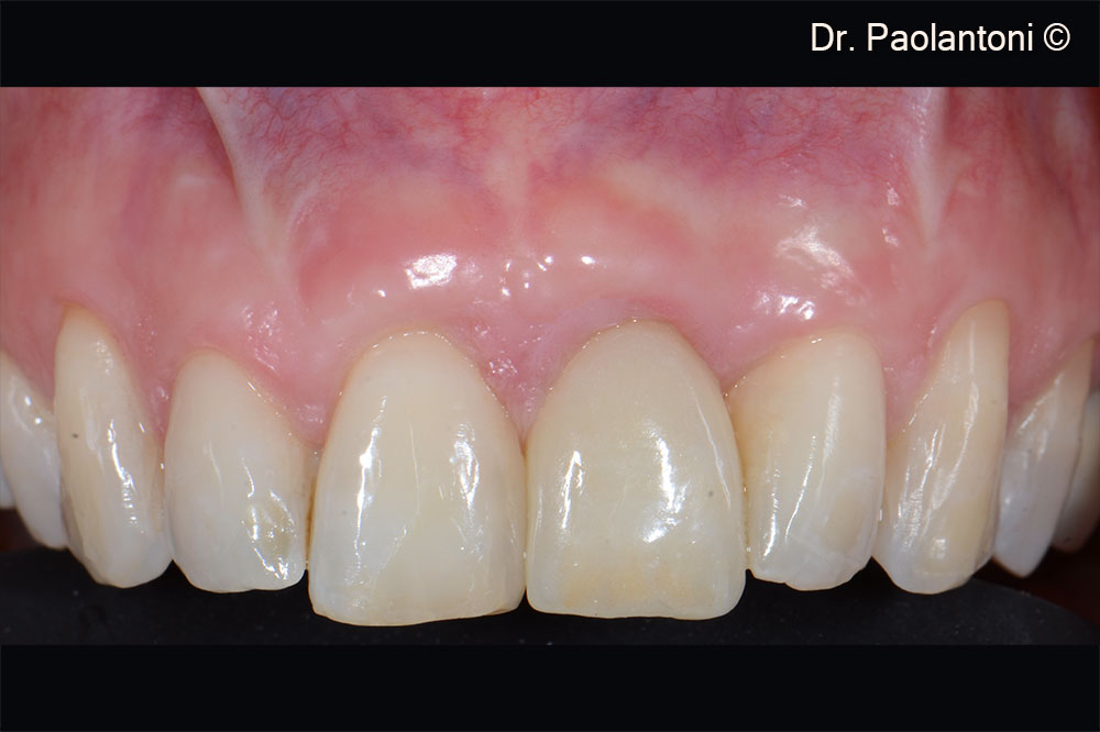 Definitive screw-retained zirconia crown