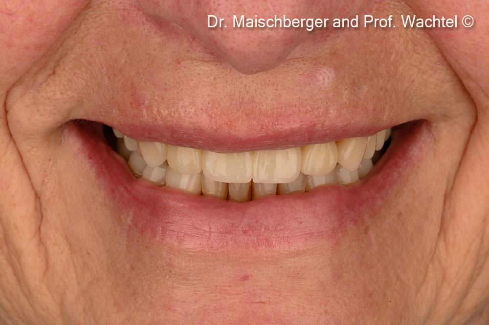 Final restoration – occlusal view – upper jaw.
