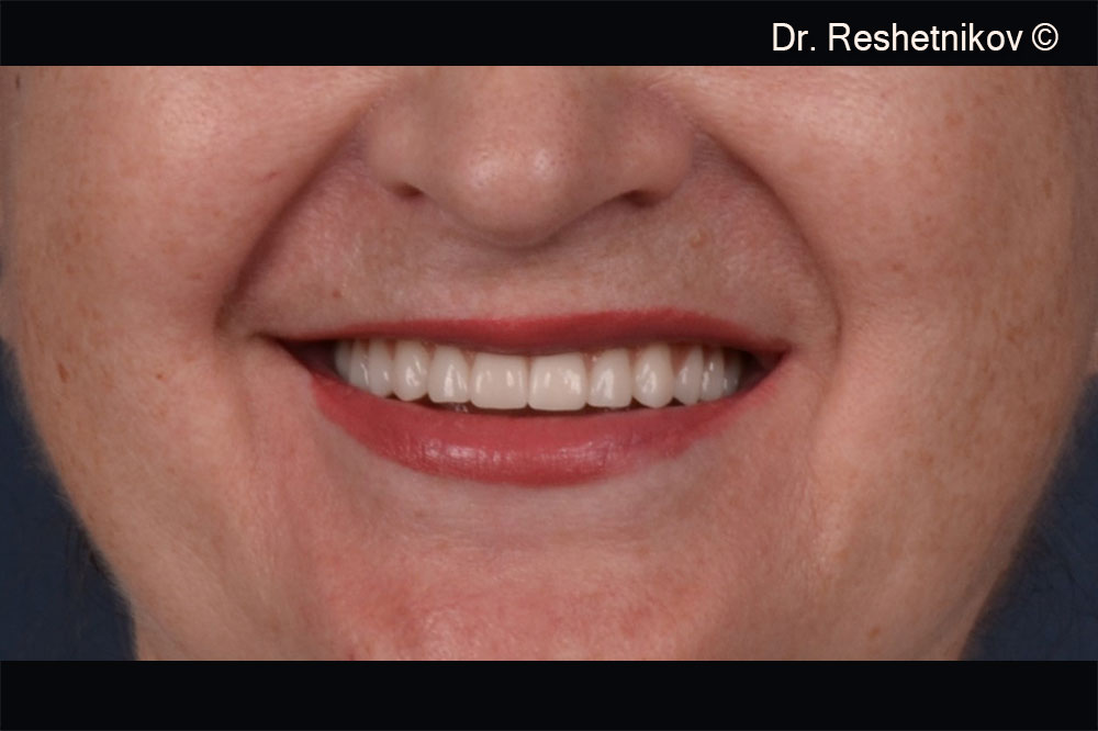 Patient's smile after permanent prosthesis fixated