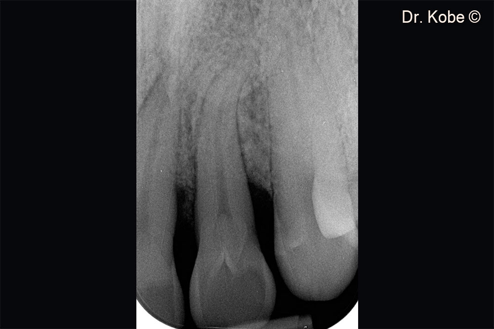 Radiograph 1 year after treatment