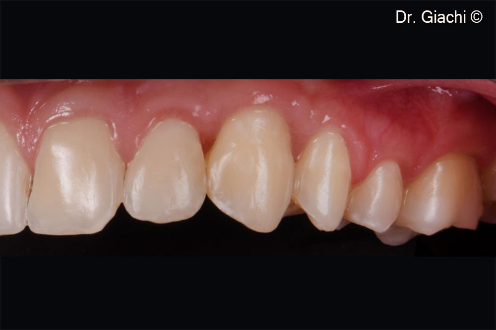 3-year follow up