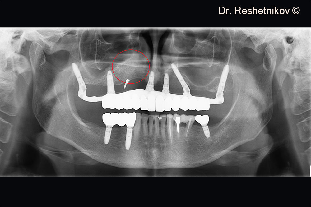 Panoramic radiograph 6 months after implantation with a permanent prosthesis installed on the upper jaw. In oroantral anastomosis of the upper jaw there is a significant increase in bone tissue with the restoration of a new anterior maxillary wall on the right