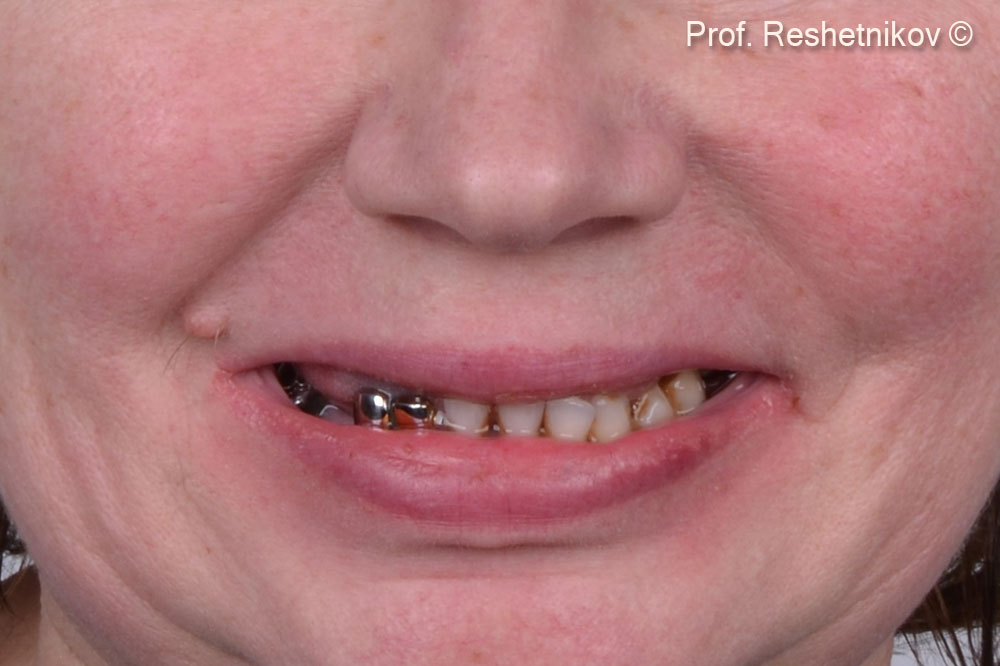 Patient complaints: lack of several teeth and mobility of the old fixed denture on the upper jaw. Initial situation