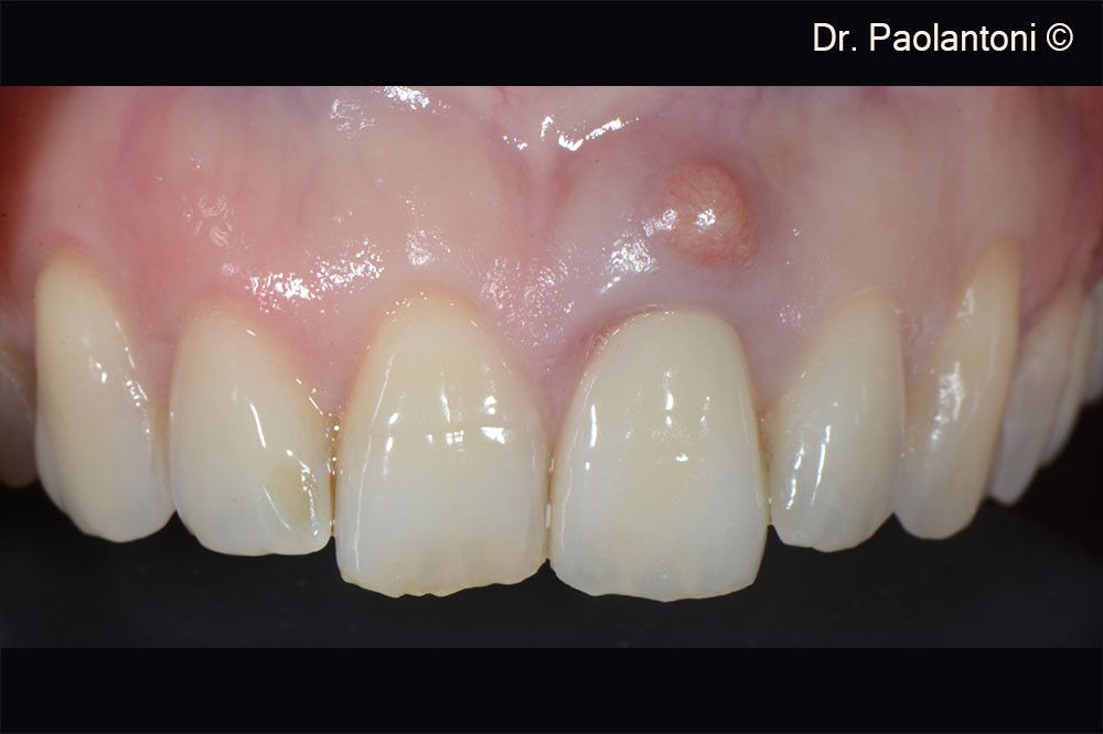 Upper left incisor with horizontal fracture of the root