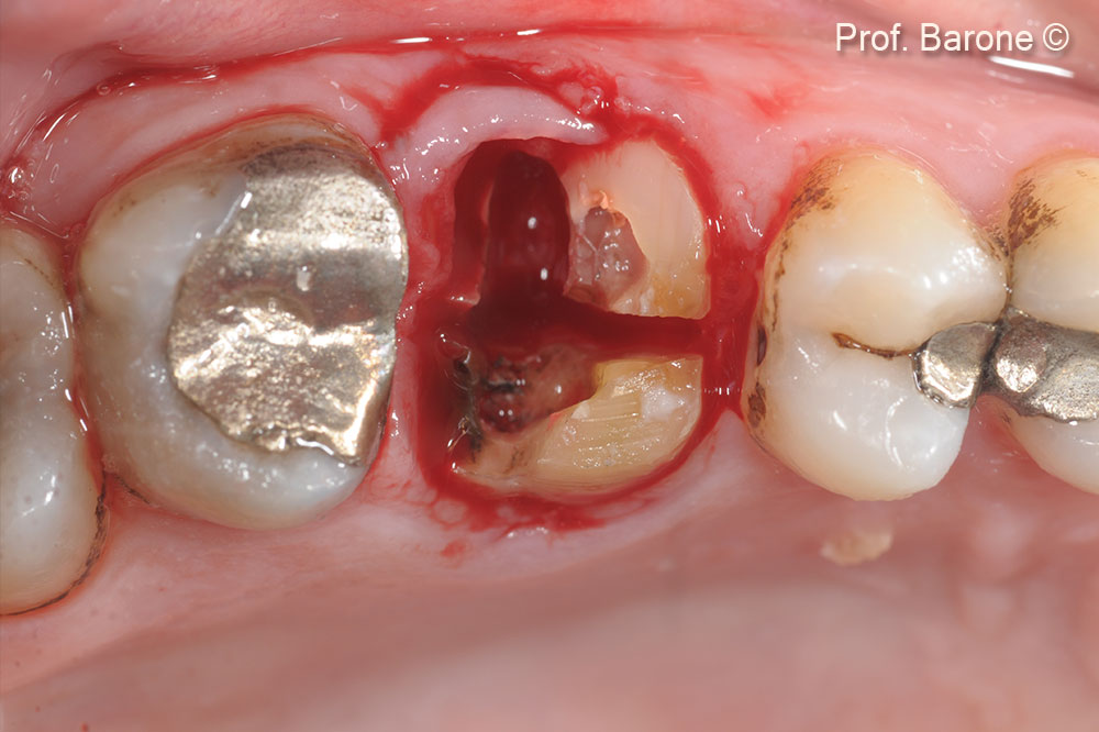 Occlusal view. Tooth n 26