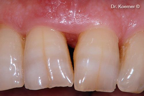 Localized periodontal defect 11