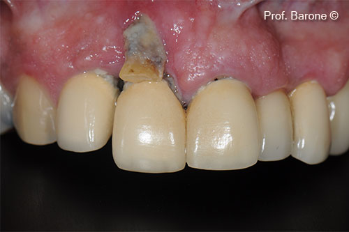 Buccal View, tooth #11