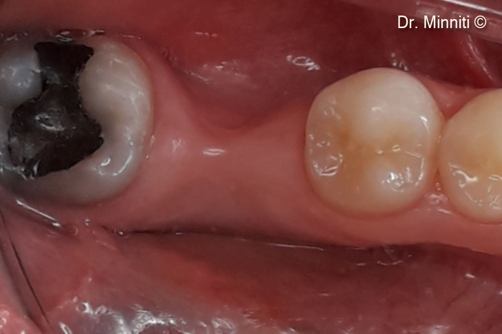 Pre-op clinical view - apical