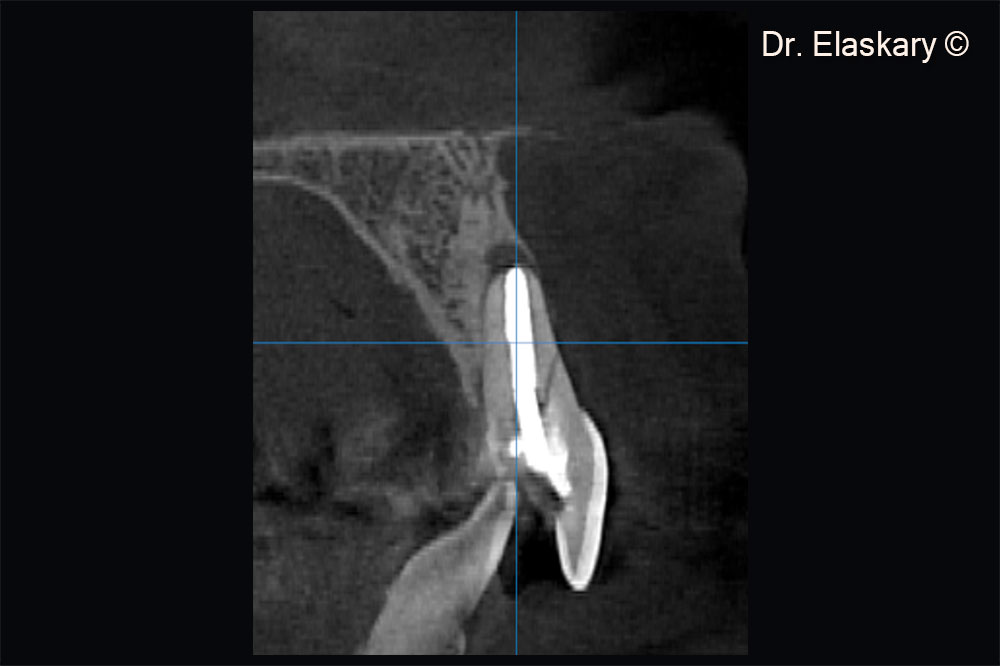 CBCT scan showing a sagittal section of broken central incisor , with lost labial plate of bone