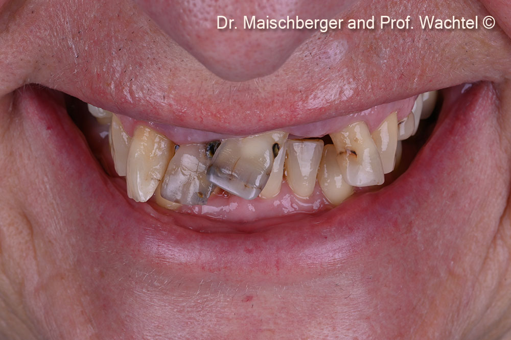 Initial situation. Full smile. First dental visit in 20 years: tilted and crowded teeth presenting high tooth mobility.