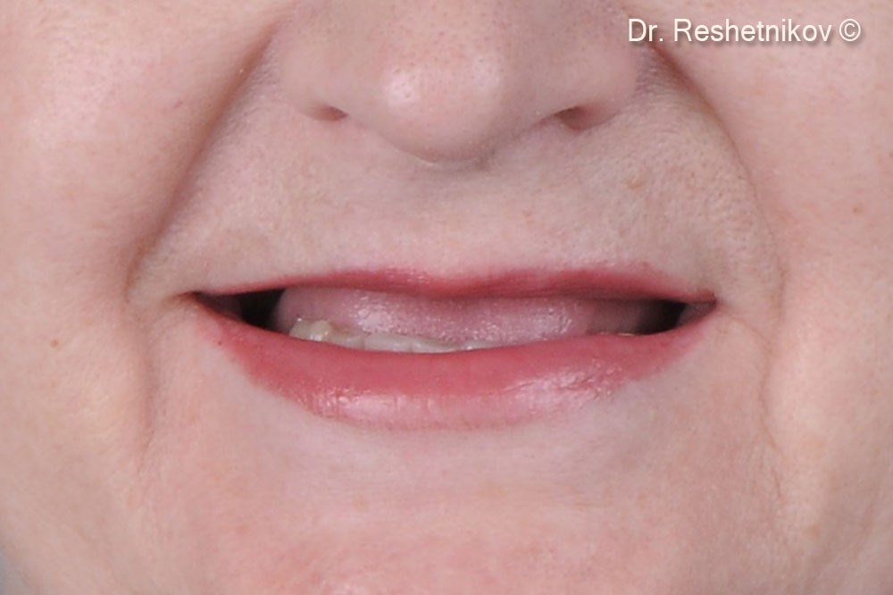 Patient complaints: lack of teeth in the upper jaw, impaired diction and discomfort when using a removable denture