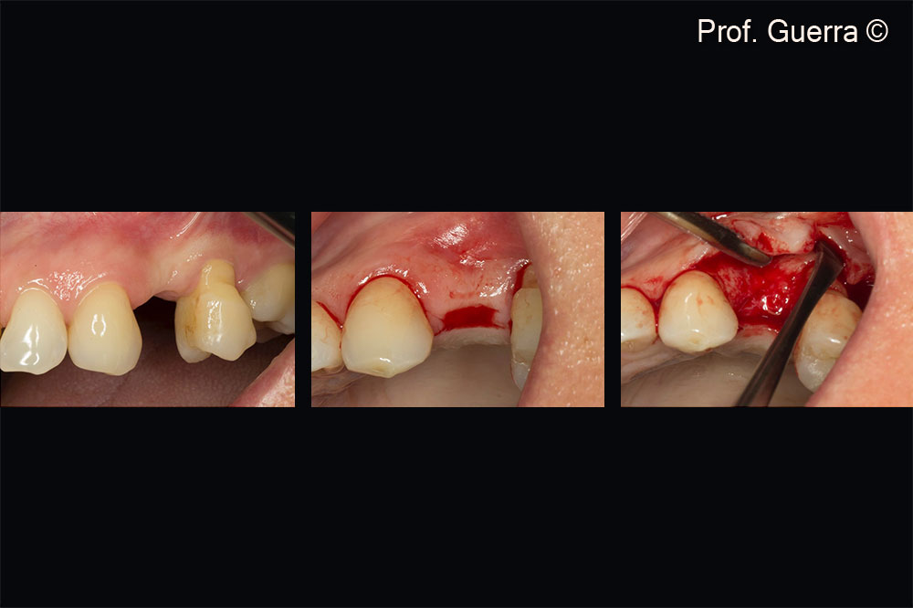 Left) missing first upper left premolar (24); Middle) envelop incision; Right) full flap thickness