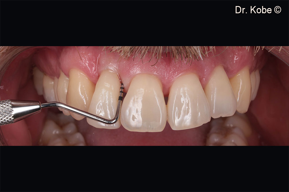 Initial situation in the first quadrant