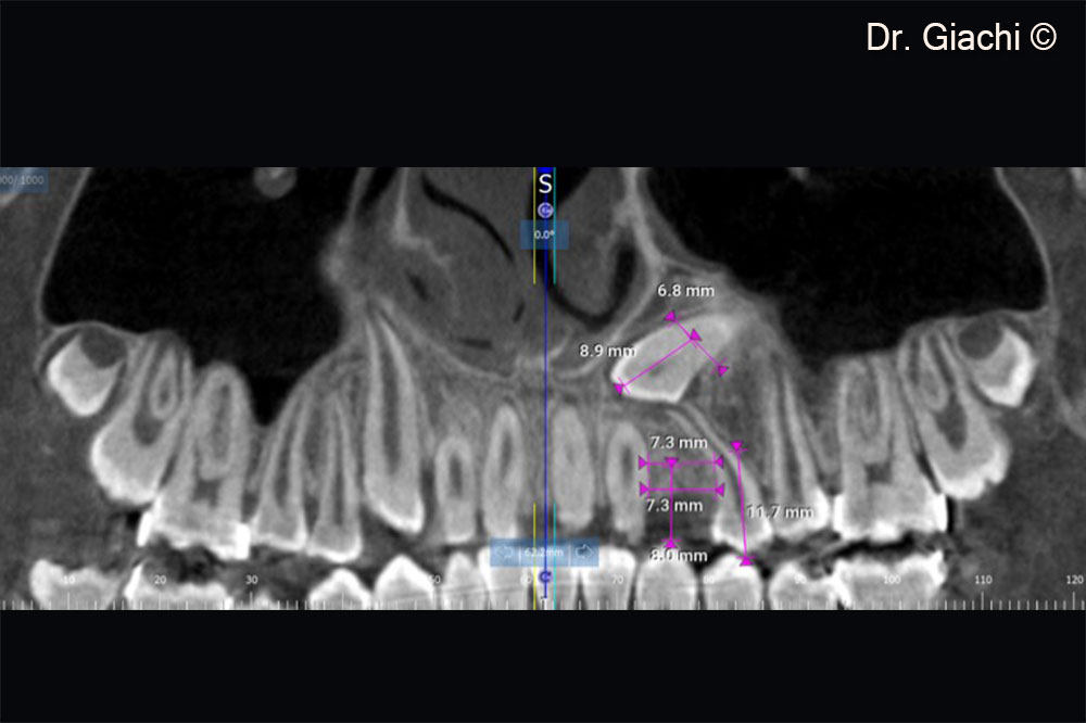 CBCT pre-op – Superior cuspid unrecoverable with traditional orthodontic treatment