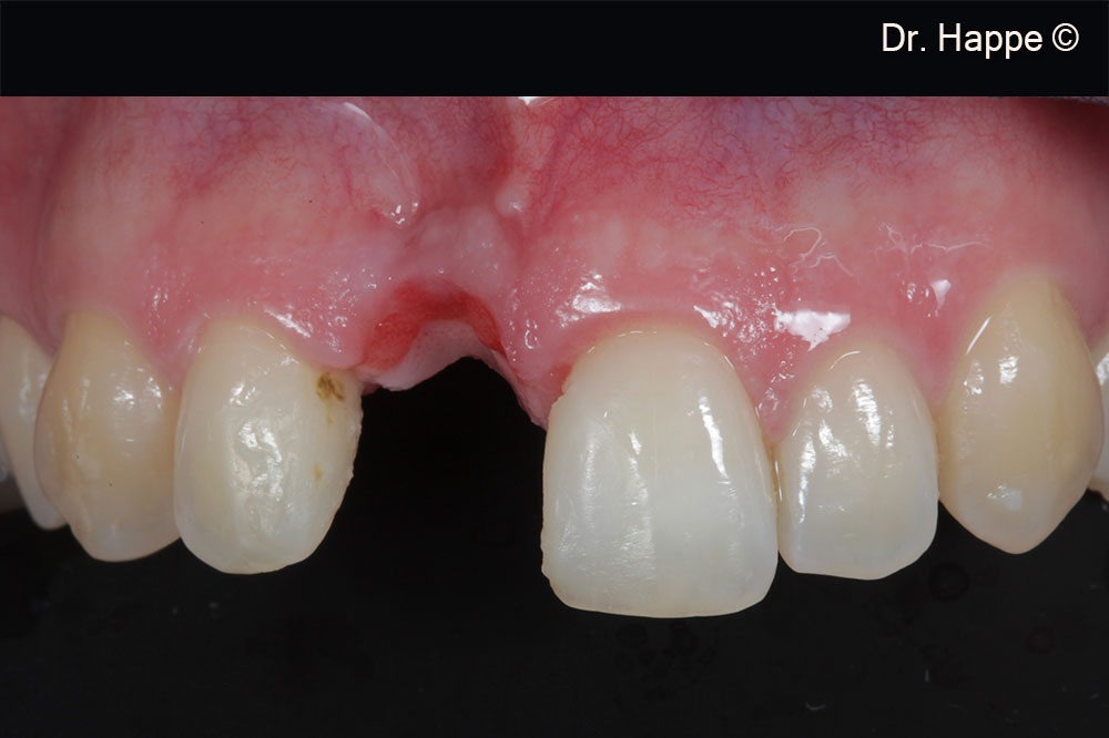 Initial clincial situation with missing right central incisor. After trauma in childhood the tooth experienced retention and external resorption.