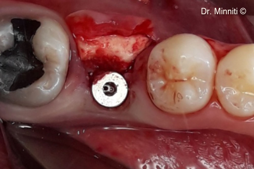 Derma 2 mm is used to thicken the peri-implant soft tissue