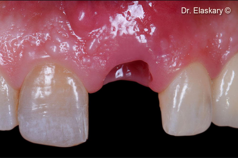 Frontal view of the location after the tooth is extracted and the socket debrided