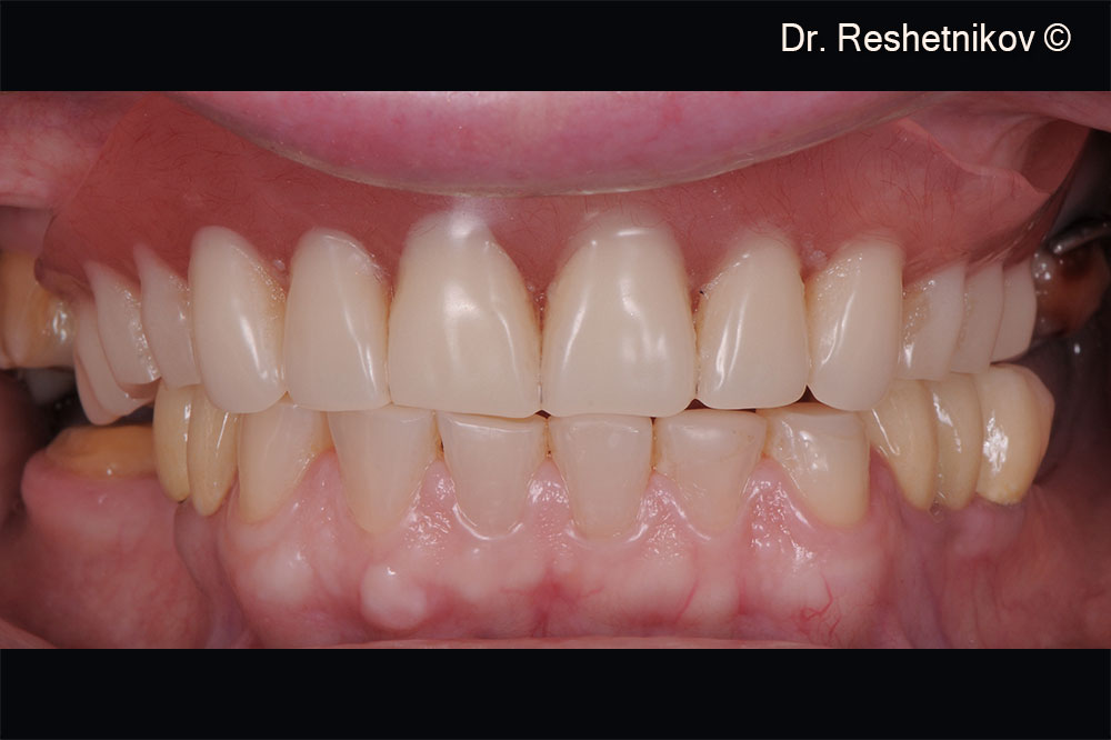 Patient complaints: lack of teeth in the upper jaw, impaired diction and discomfort when using a removable denture