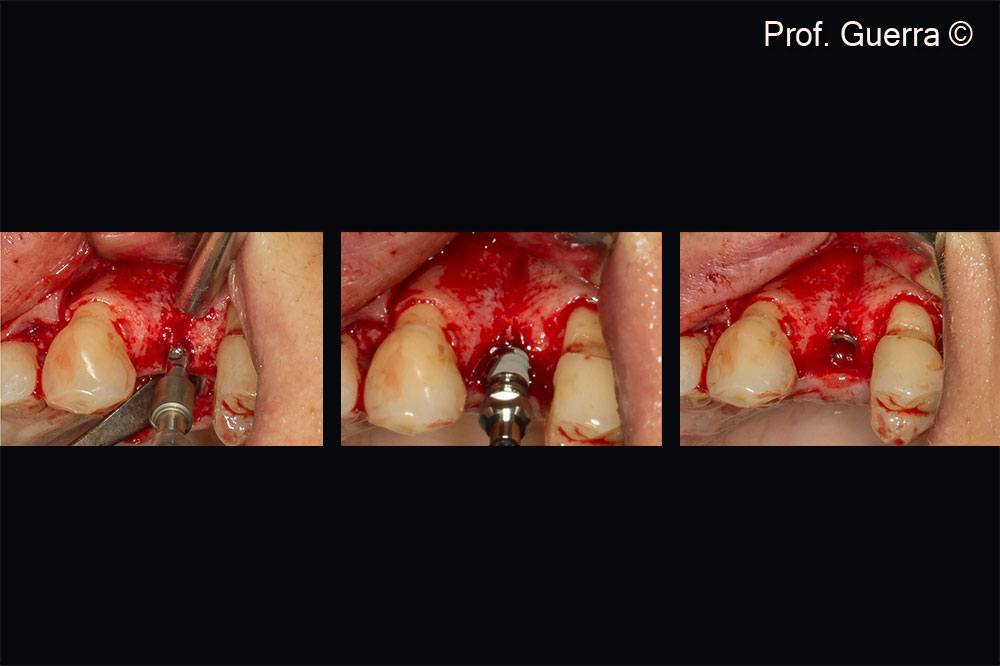 Left) pilot drill; Middle) implant insertion; Right) implant placement (Camlog Screw-linw 3.3mm, 13mm) and dehiscence defect