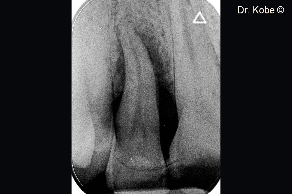 Vertical bone defect on the radiograph