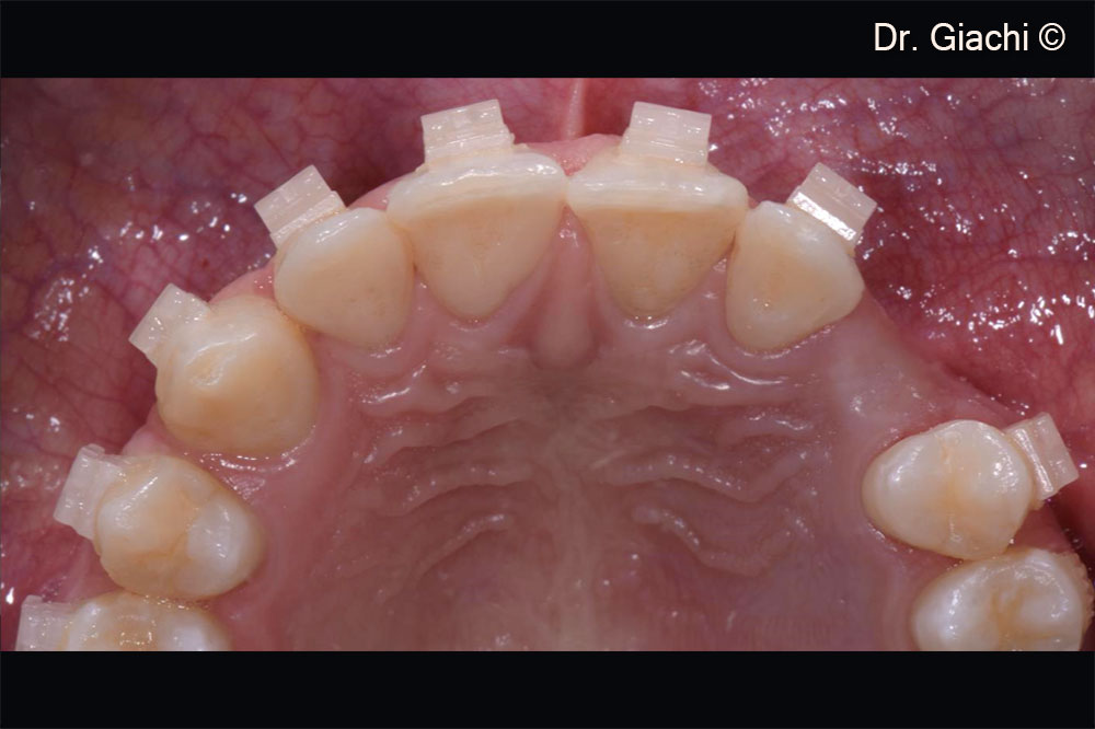 Orthodontic treatment in order to create the correct space