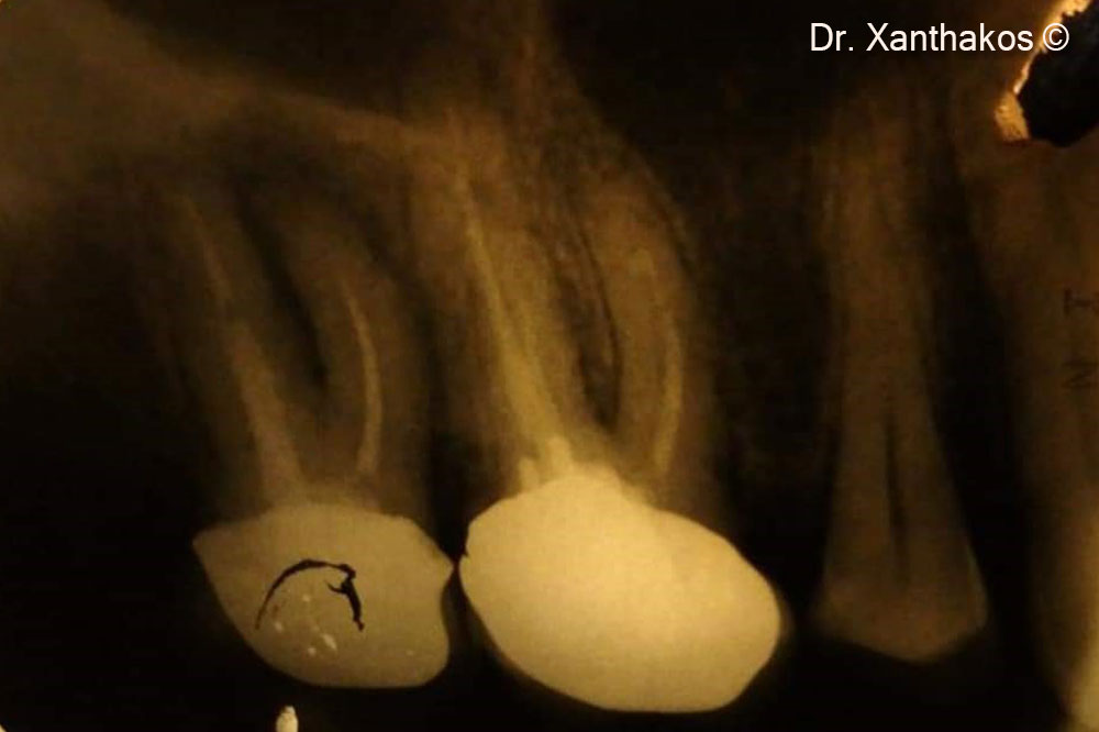 Immediate (after extraction of molars 16,17) placement of two blue sky implants in the position of the palatal roots