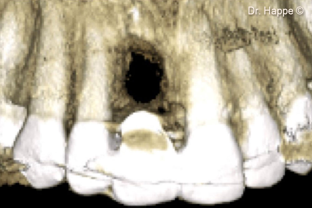 Screenshot of CBST Scan. Class V Defect with missing palatal wall.
